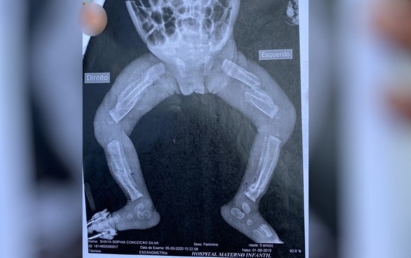 Bebê espancado por casal maranhense morre em hospital de Goiânia