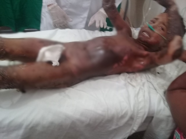 BURITICUPU - Criança tem corpo queimado em carvoaria 