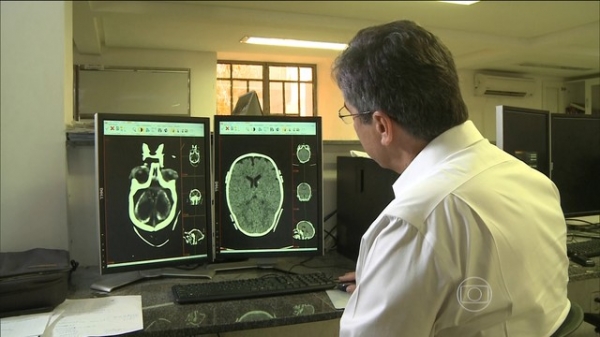 Sobe para 80 número de casos de microcefalia no Maranhão