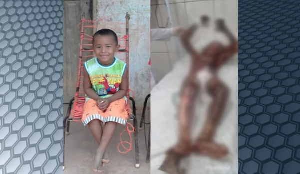 Hospital divulga boletim sobre estado de saúde de garoto queimado