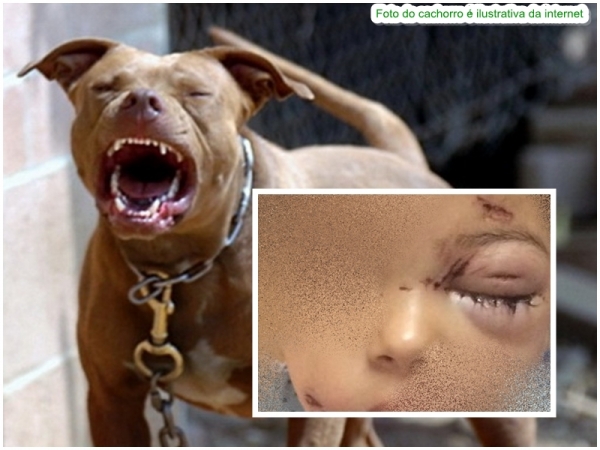 Menina de apenas cinco anos é mordida por pitbull em bairro de Açailândia