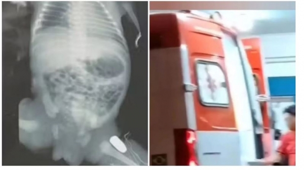 BEBÊ SEGUE ESTÁVEL APÓS CIRURGIA PARA RETIRAR PROJÉTIL DA PERNA