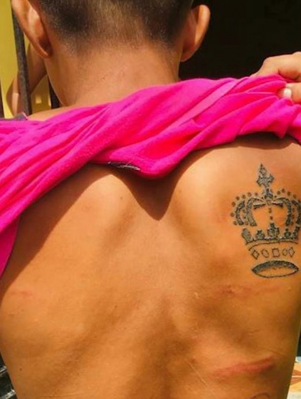 Mãe é presa após queimar o filho com ferro quente no Maranhão