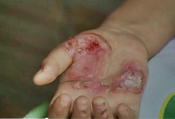 'Não terá sequelas físicas', dizem médicos sobre criança torturada pela mãe em Apicum-Açu