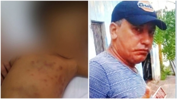 MARANHÃO - Criança espancada pela mãe pode ter sido abusada sexualmente pelo padastro, afirma polícia no MA