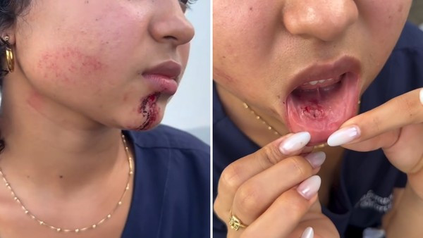 JOVEM É AGREDIDA NO ROSTO POR HOMEM DENTRO DE ÔNIBUS EM SÃO LUÍS; POLÍCIA INVESTIGA O CASO COMO ROUBO