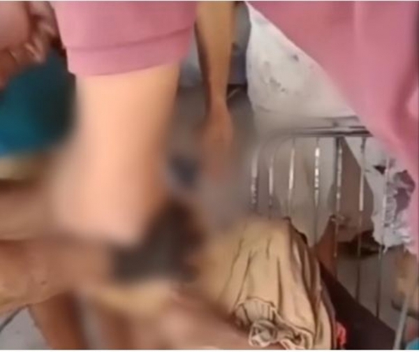 Moradores de Coroatá socorrem criança com panela de pressão presa na cabeça